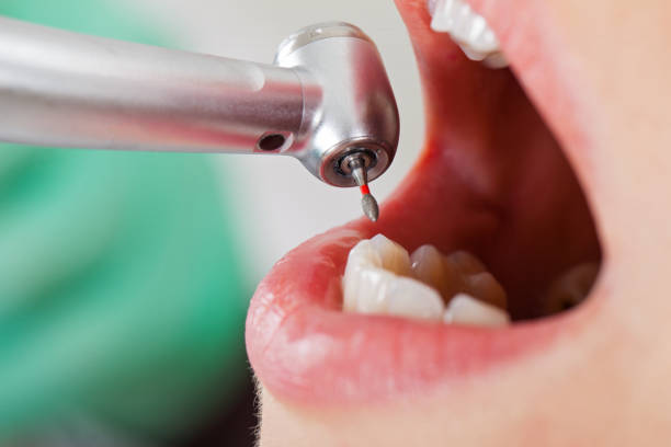 Best Emergency Wisdom Tooth Extraction in North Richland Hills, TX